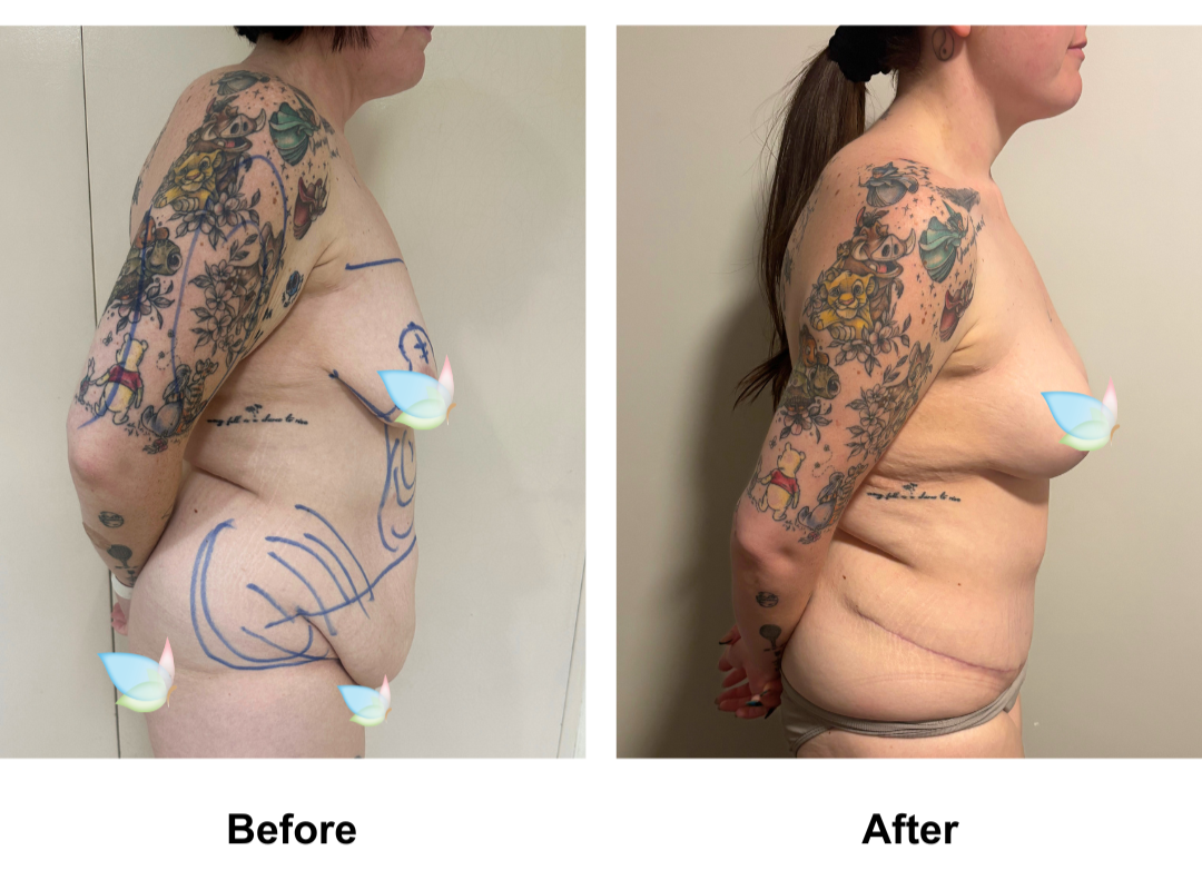 Rhiannon had BABL+ AL + Lipo arm + ExTT + ML + Lipo2 with Dr. Kasemsak