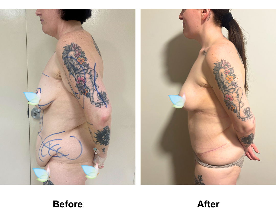 Rhiannon had BABL+ AL + Lipo arm + ExTT + ML + Lipo_2 with Dr. Kasemsak (2)