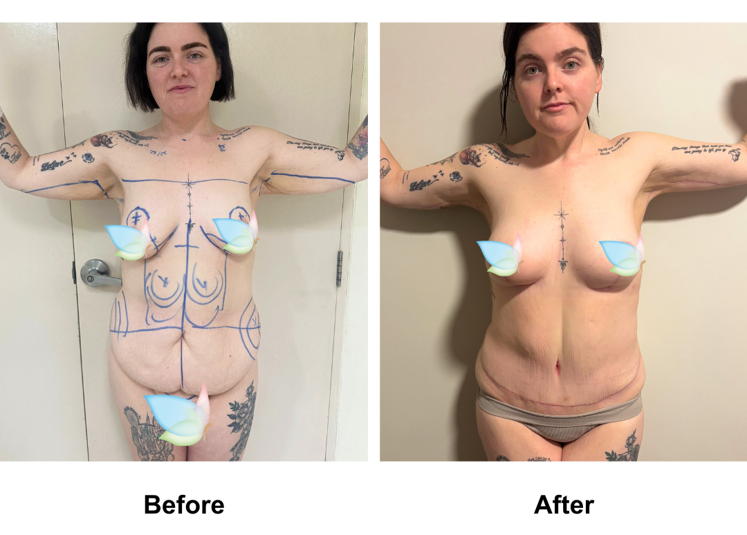 Rhiannon had BABL+ AL + Lipo arm + ExTT + ML + Lipo_2 with Dr. Kasemsak