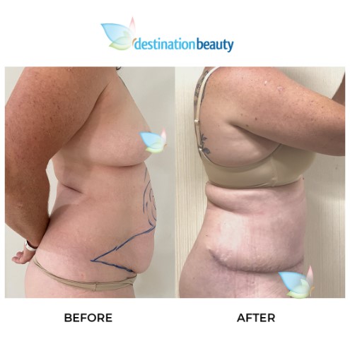 Robyn extended tummy tuck and lipo 2