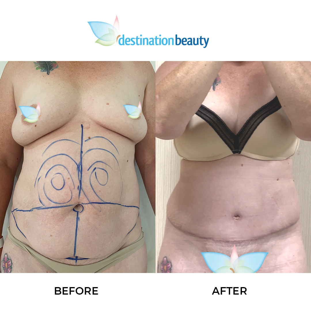 Robyn extended tummy tuck and lipo