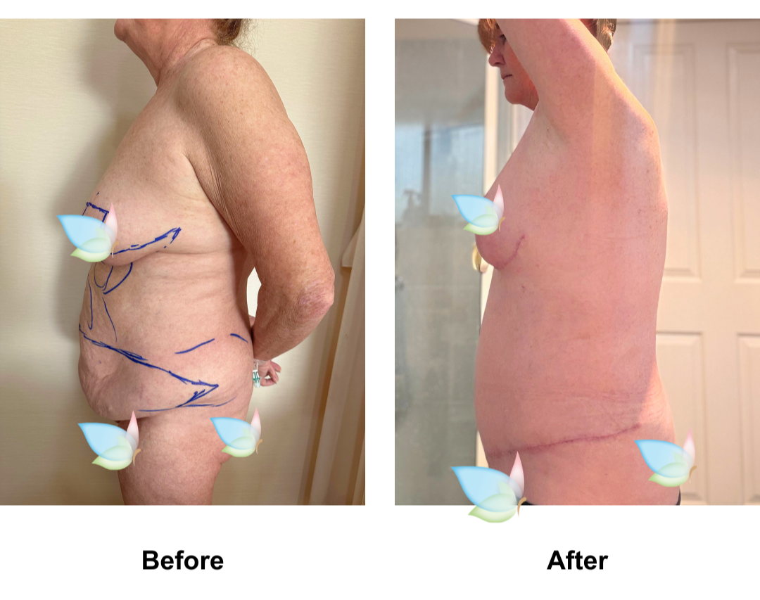 Robyn had BABL + ExTT + Lipo2 + Mon pubis lift (1)