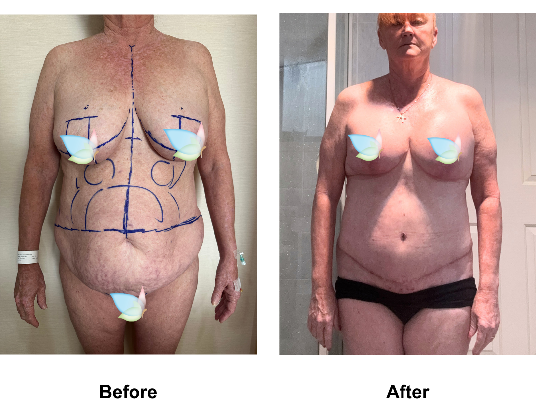 Robyn had BABL + ExTT + Lipo2 + Mon pubis lift