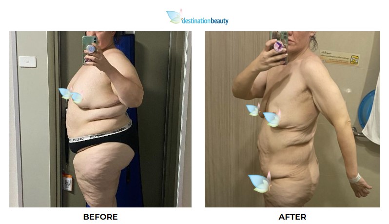 Robyn weight loss surgery