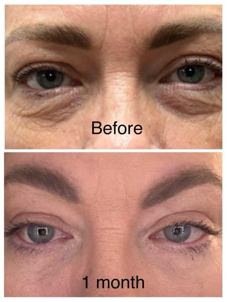 Rochelle had a facelift and lower eyelid surgery with Dr. NJ