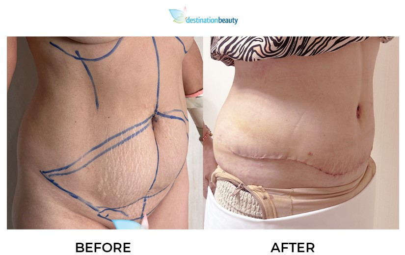 Ruby before after tummy tuck-1