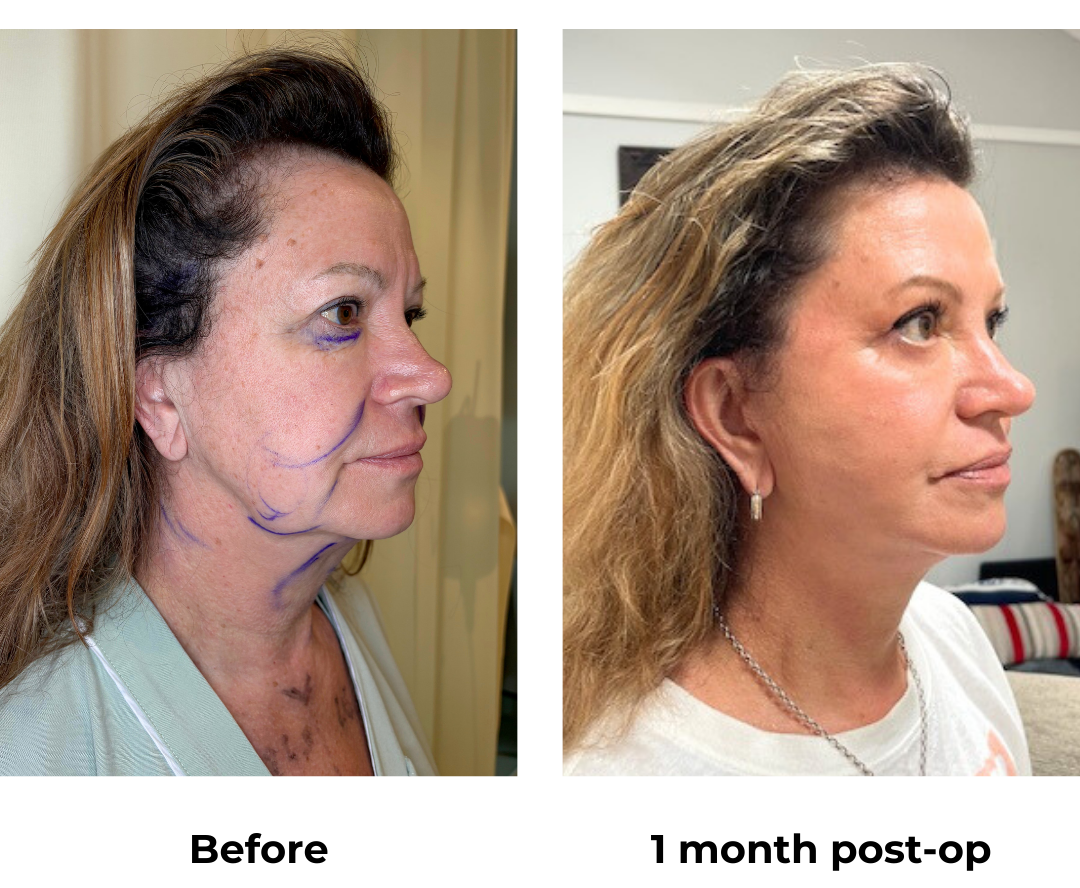 Ruth had MFNL + LB + chin Lipo with Dr. Jatuporn (2)