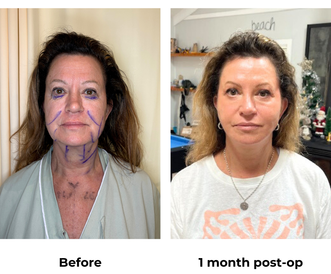 Ruth had MFNL + LB + chin Lipo with Dr. Jatuporn