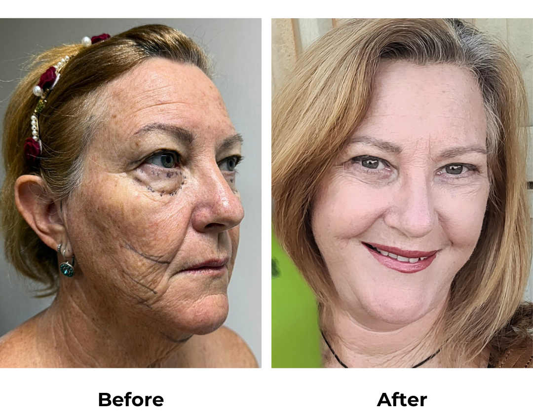 Sally had MFNL + Chin lift + ULB with Dr. Ring (2)