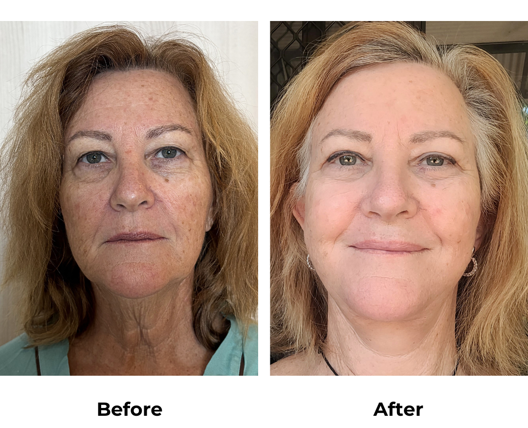 Sally had MFNL + Chin lift + ULB with Dr. Ring-1