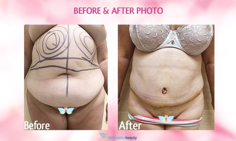 Sally's before and after tummy tuck thailand
