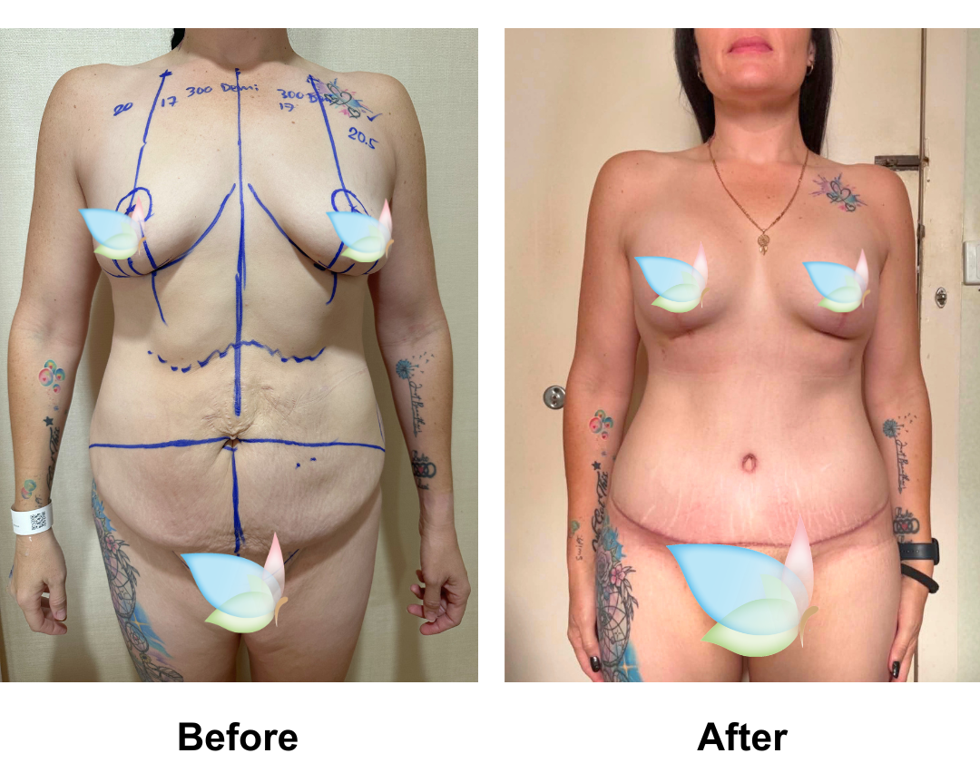 Sam had BABL + Ex TT + Mon lift + Lipo2 with Dr. Angkana  (1)