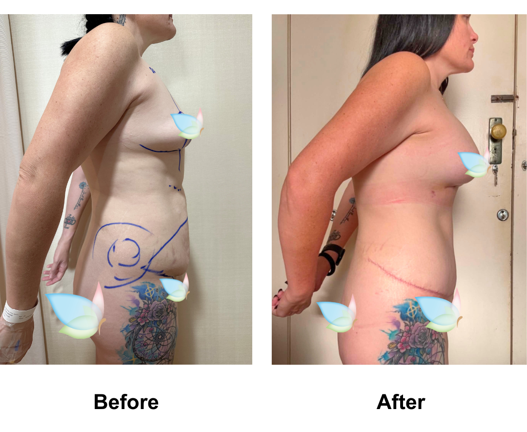 Sam had BABL + Ex TT + Mon lift + Lipo2 with Dr. Angkana  (2)