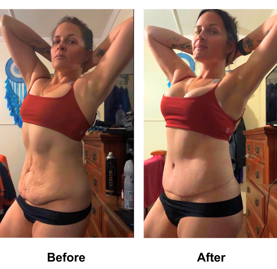 Sam had BABL + Ex TT + Mon lift + Lipo2 with Dr. Angkana