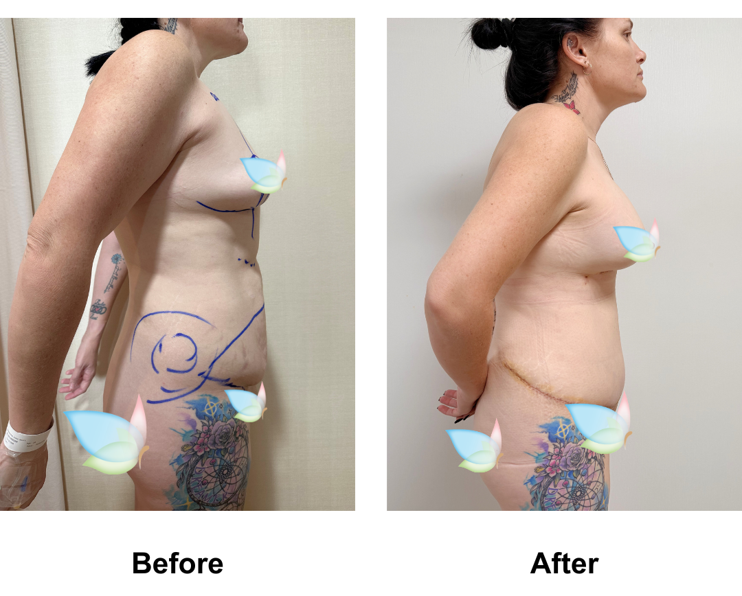 Sam had BABL + Ex TT + Mon lift + Lipo_2 with Dr. Angkana (2)-1