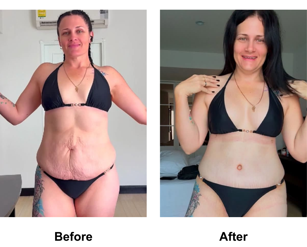 Sam had BABL + Ex TT + Mon lift + Lipo_2 with Dr. Angkana (2)
