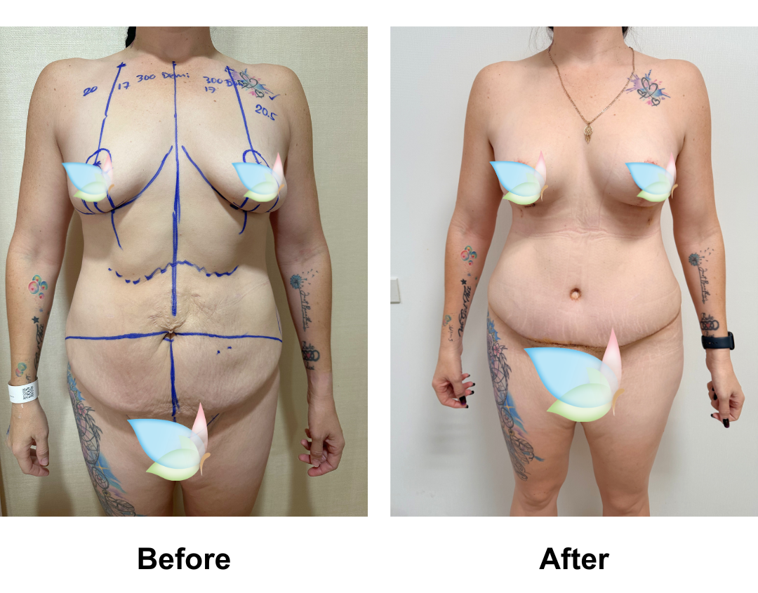 Sam had BABL + Ex TT + Mon lift + Lipo_2 with Dr. Angkana-1