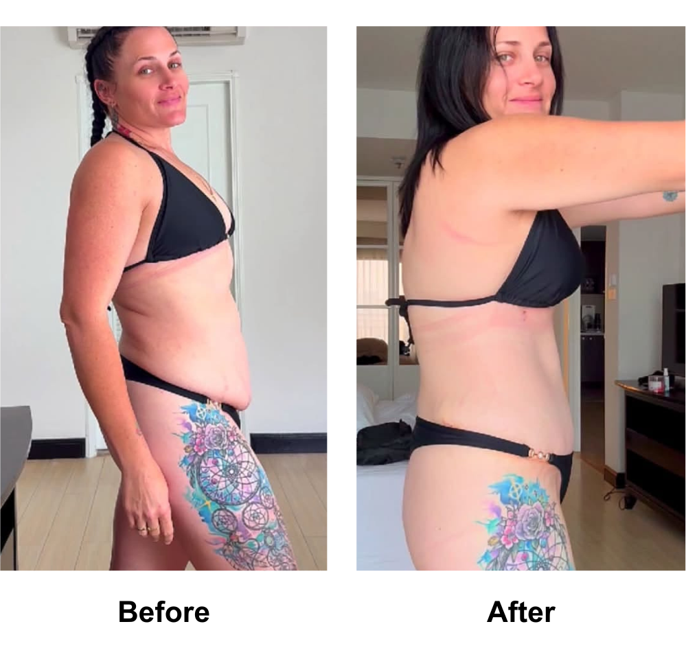 Sam had BABL + Ex TT + Mon lift + Lipo_2 with Dr. Angkana
