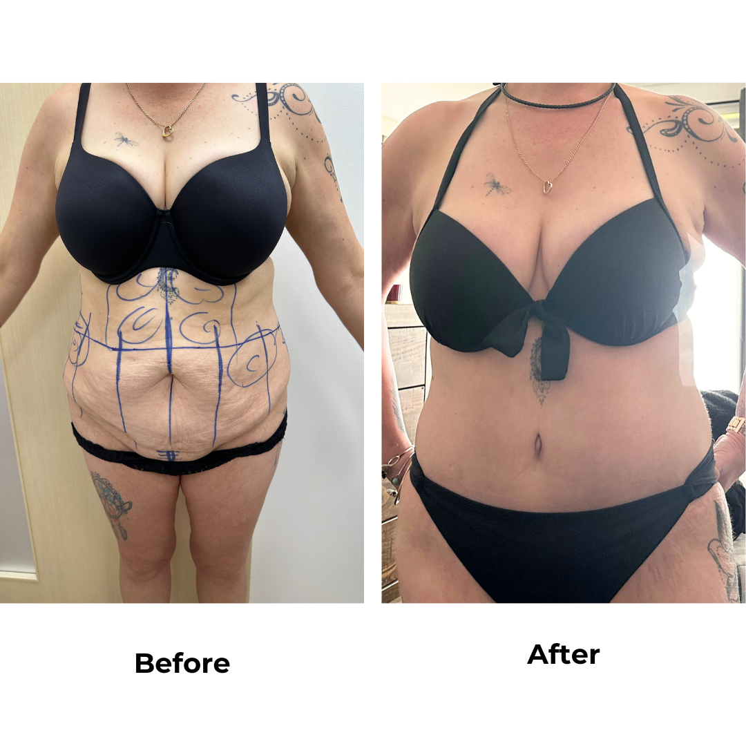 Sam had extended tummy tuck in Thailand with Dr. Jatuporn - 2 months post-op (2)