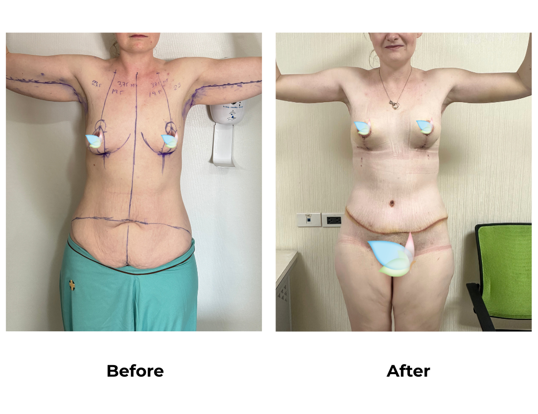 Samantha had BABL + Ex TT + arm lift - Dr. Angkana (1)