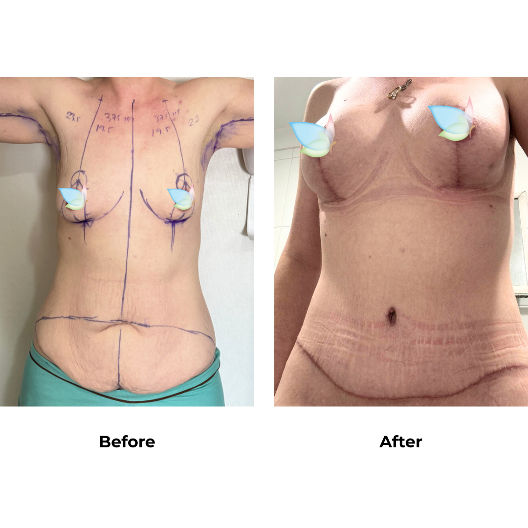 Samantha had BABL + Ex TT + arm lift - Dr. Angkana (2)