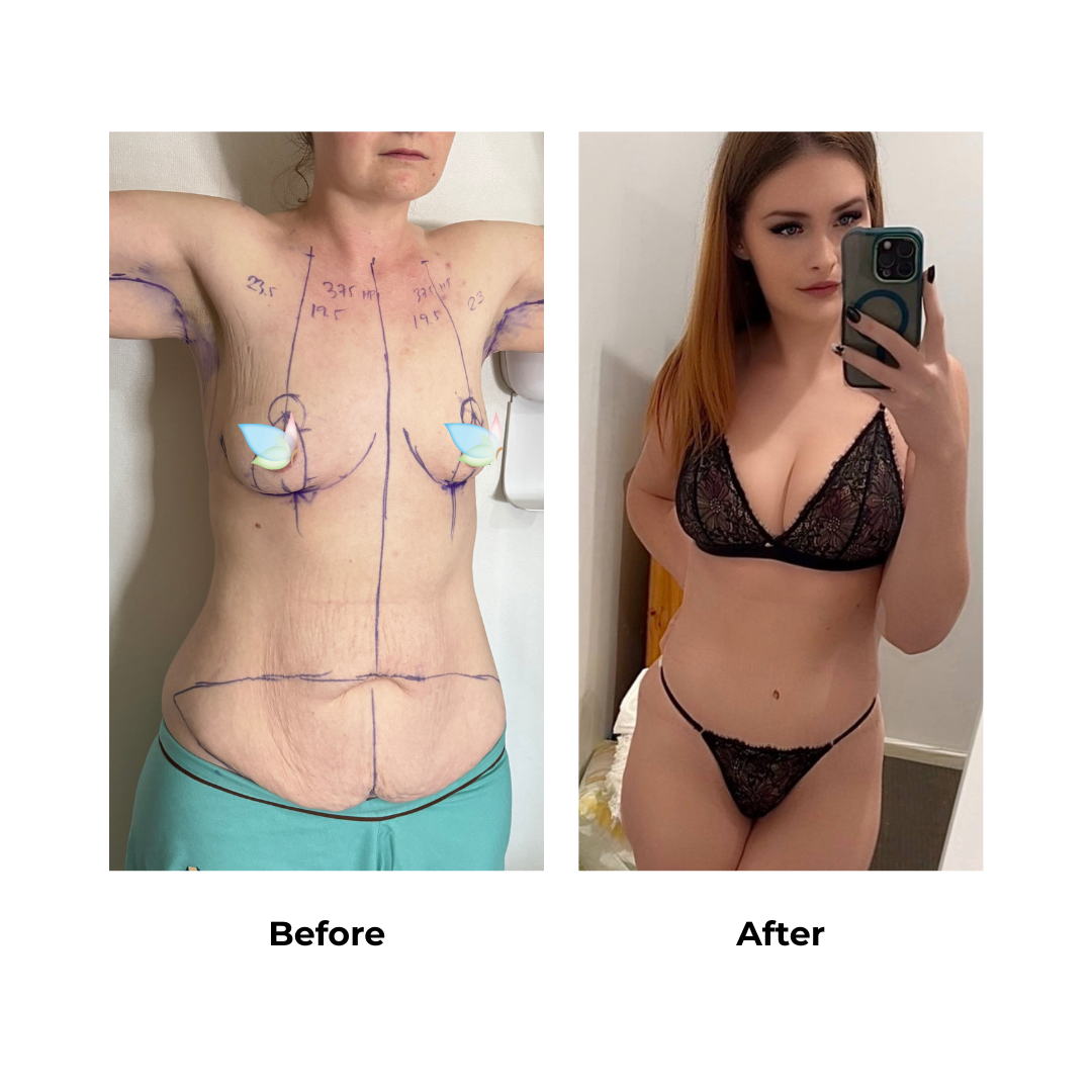 Samantha had BABL + Ex TT + arm lift - Dr. Angkana (3)
