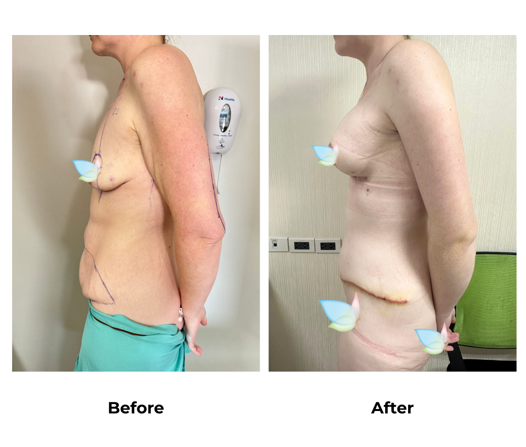 Samantha had BABL + Ex TT + arm lift - Dr. Angkana (4)