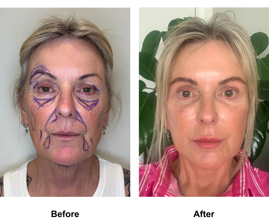 Sandra had FFNL  + Sub Brow Lift  + Fat transfer to under eyes with Dr. NJ (2)