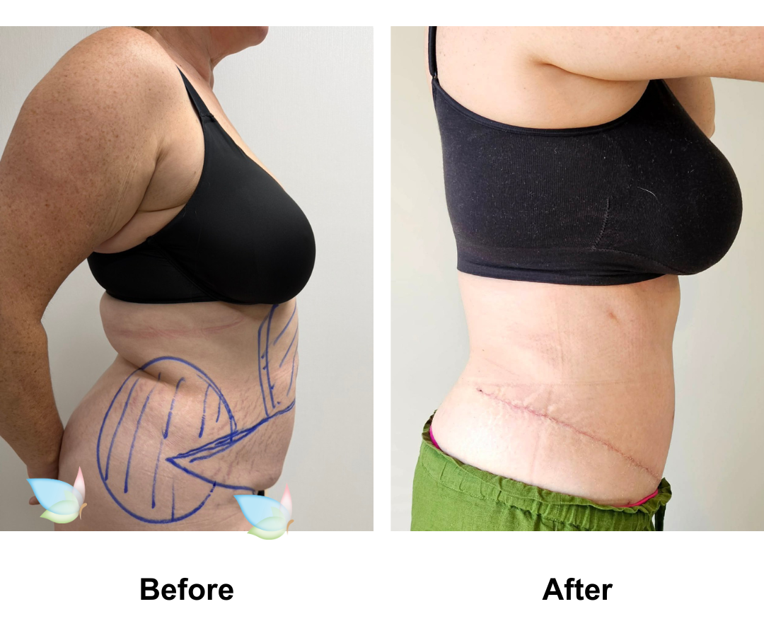 Sara had ExTT + Lipo_2 (upper abs, love handles) + ML with Dr. Ring (2)