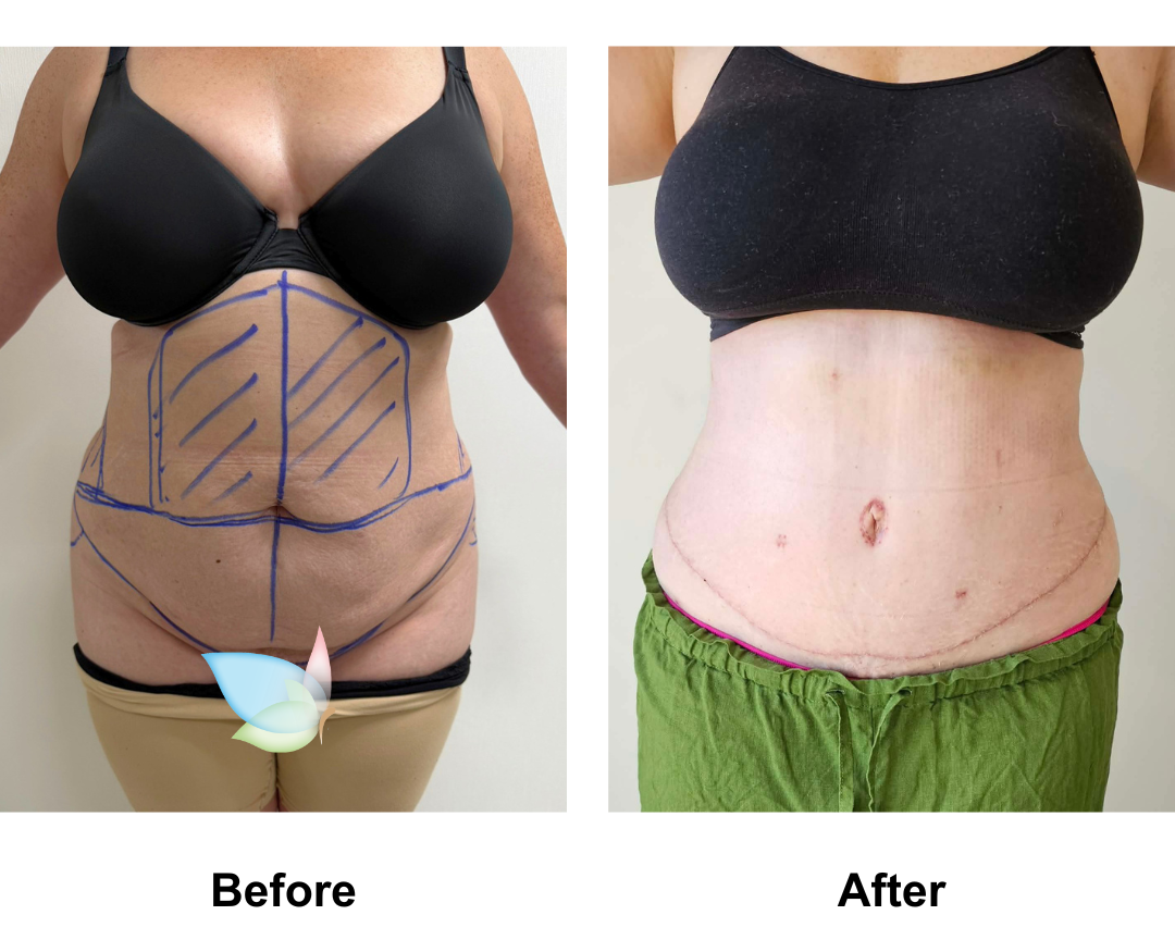 Sara had ExTT + Lipo_2 (upper abs, love handles) + ML with Dr. Ring