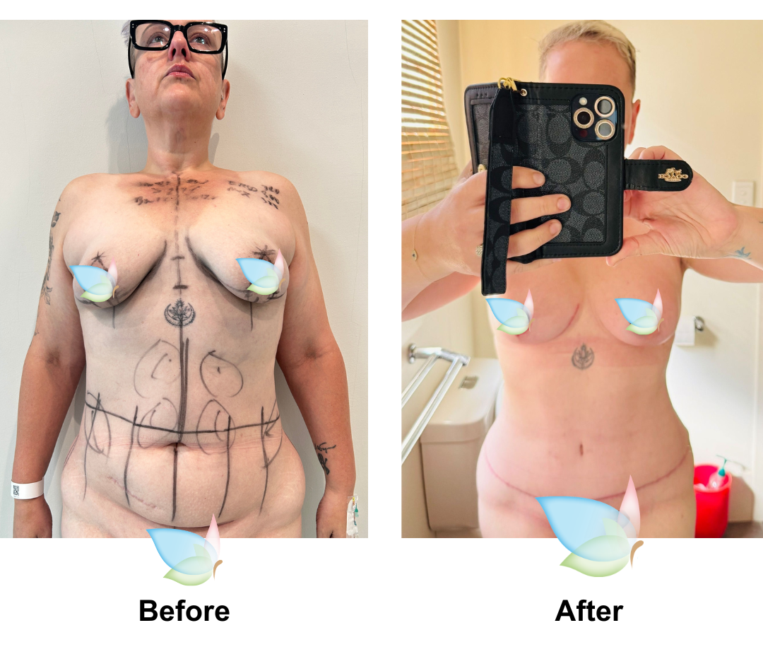 Sarah had BABL + Ex TT + Mons Lift + Vaser Lipo2 with Dr. Jatuporn