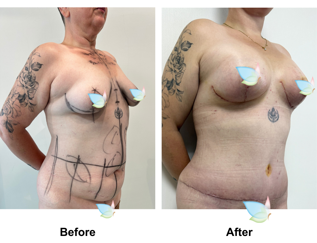 Sarah had BABL + Ex TT + Mons Lift + Vaser Liposuction x2 (upper abs and love handles) (2)