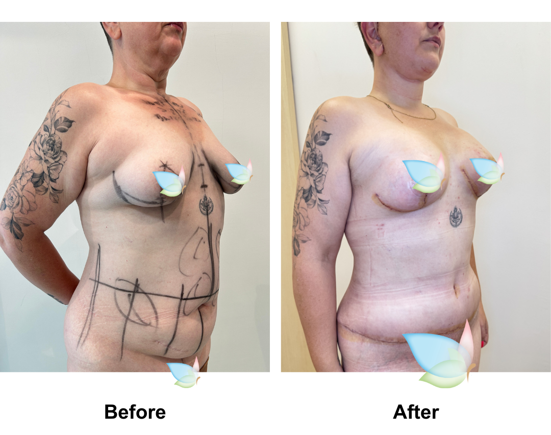 Sarah had BABL + Ex TT + Mons Lift + Vaser Liposuction x2 (upper abs and love handles) + PICO (10x30)  (1)