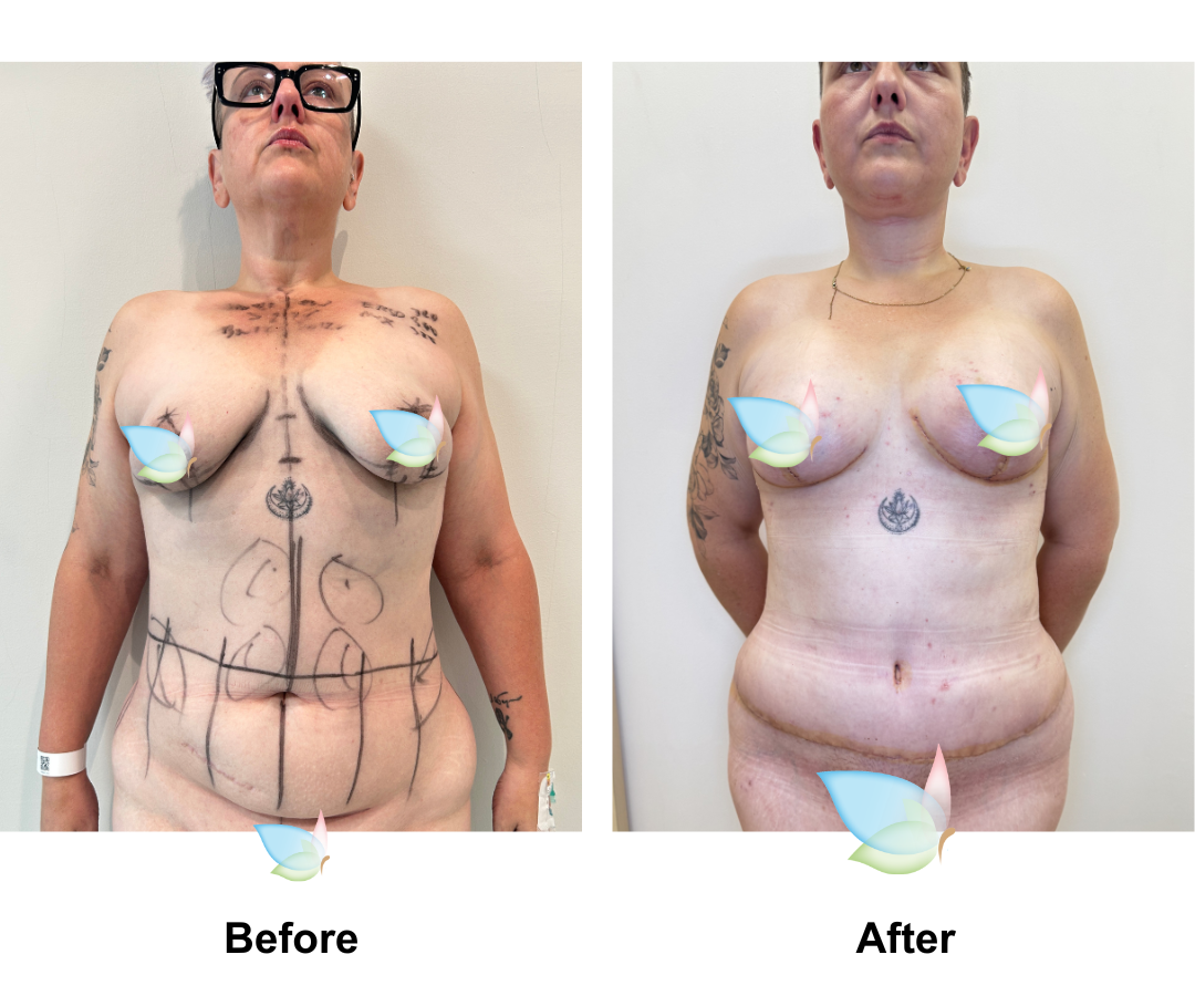 Sarah had BABL + Ex TT + Mons Lift + Vaser Liposuction x2 (upper abs and love handles) + PICO (10x30)
