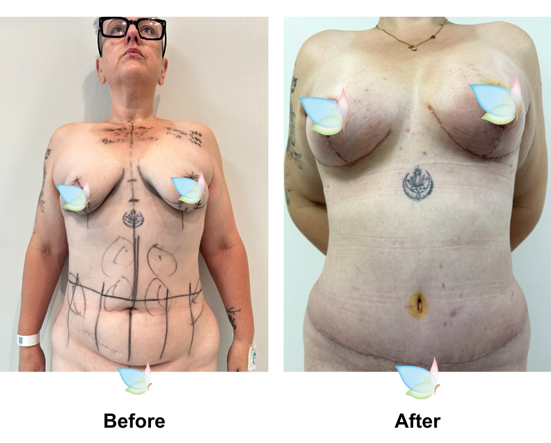 Sarah had BABL + Ex TT + Mons Lift + Vaser Liposuction x2 (upper abs and love handles)