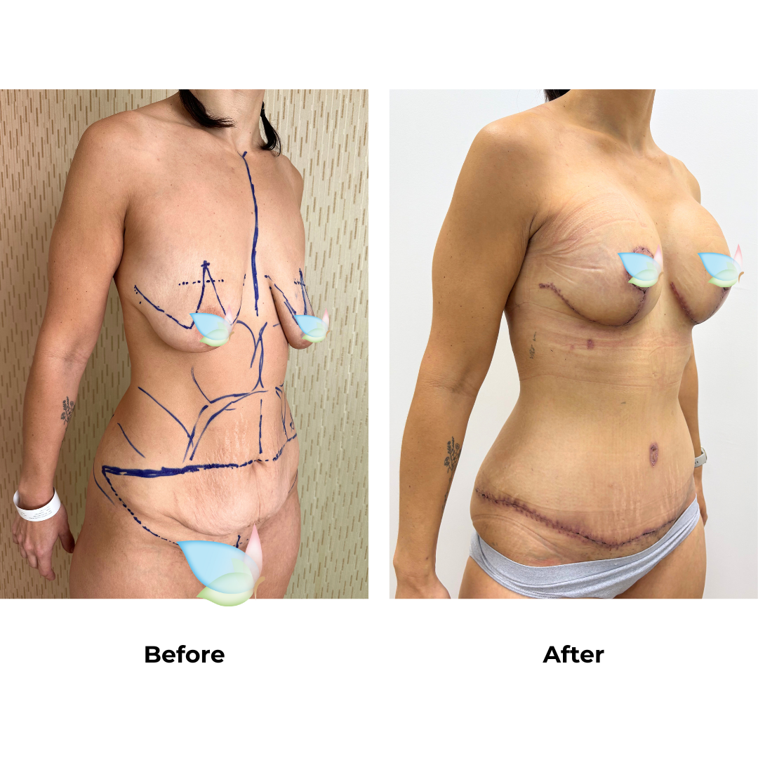 Sarah had BABL+ExTT+LipoX2 - Sarah Nobbs with Dr. Jatuporn (2)