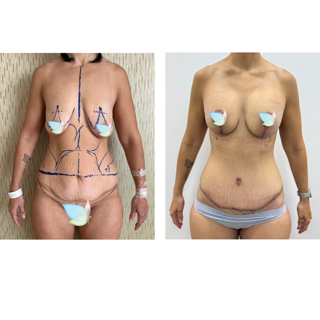Sarah had BABL+ExTT+LipoX2 - Sarah Nobbs with Dr. Jatuporn