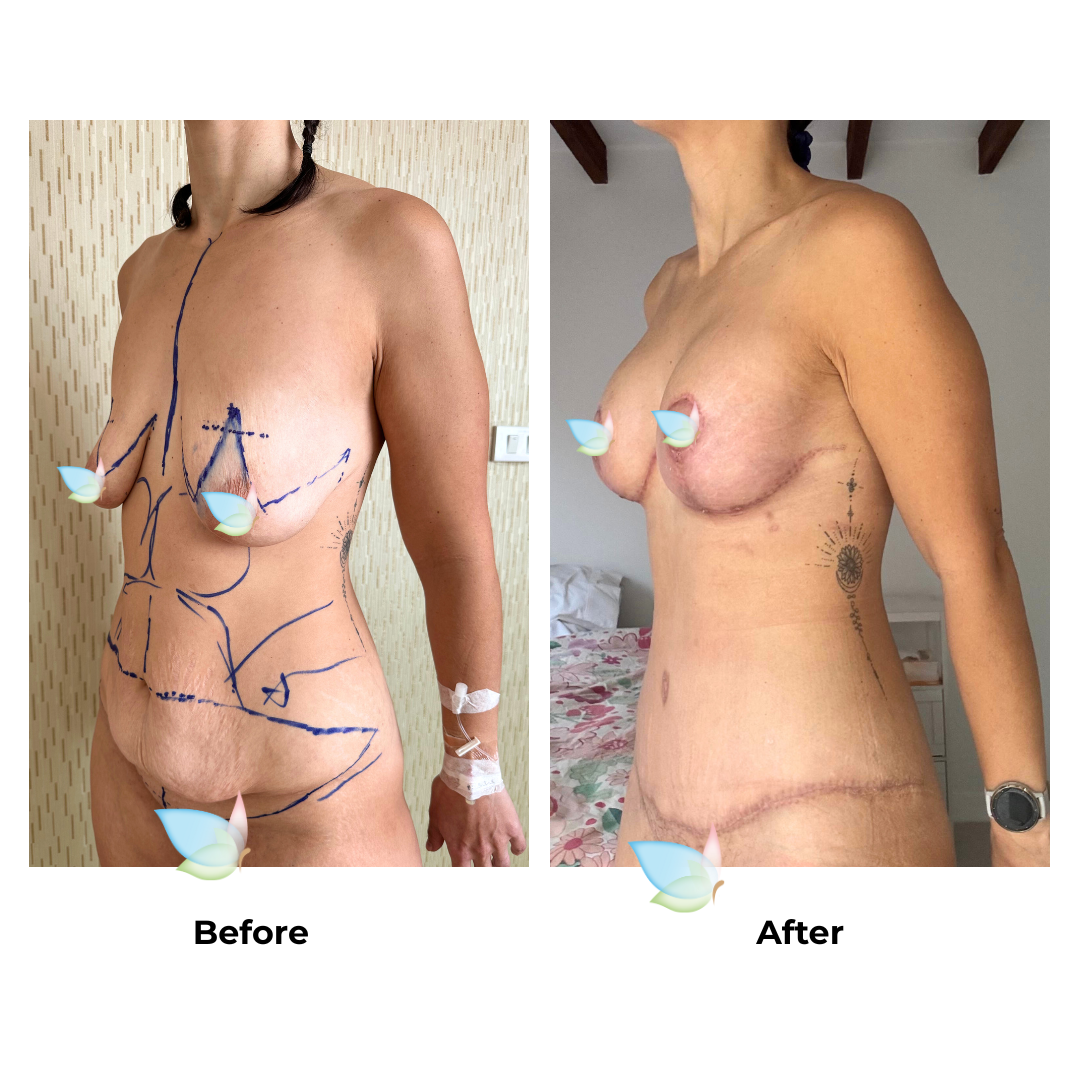 Sarah had BABL+ExTT+LipoX2 - Sarah Nobbs with Dr. Weerachai (2)