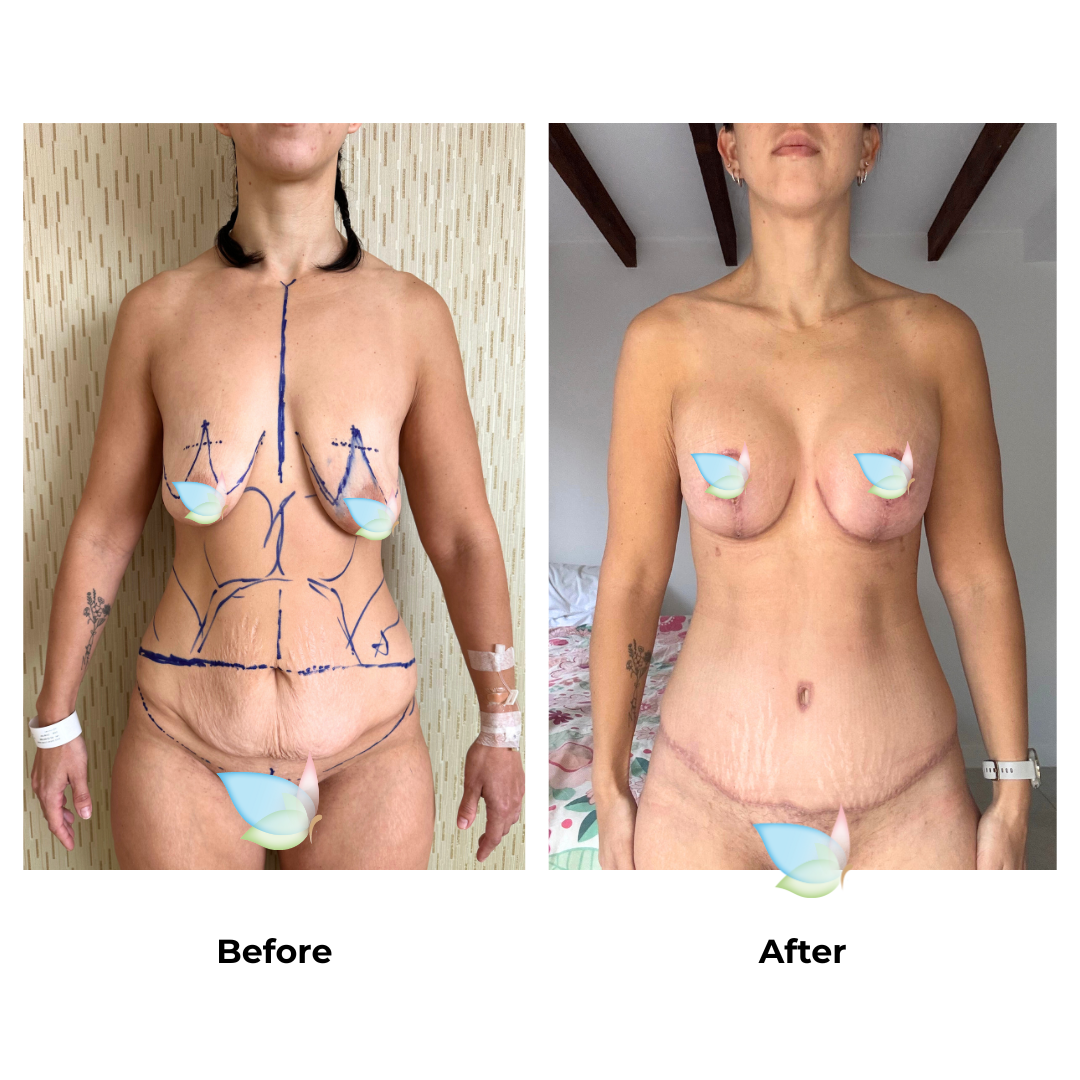 Sarah had BABL+ExTT+LipoX2 - Sarah Nobbs with Dr. Weerachai (3)