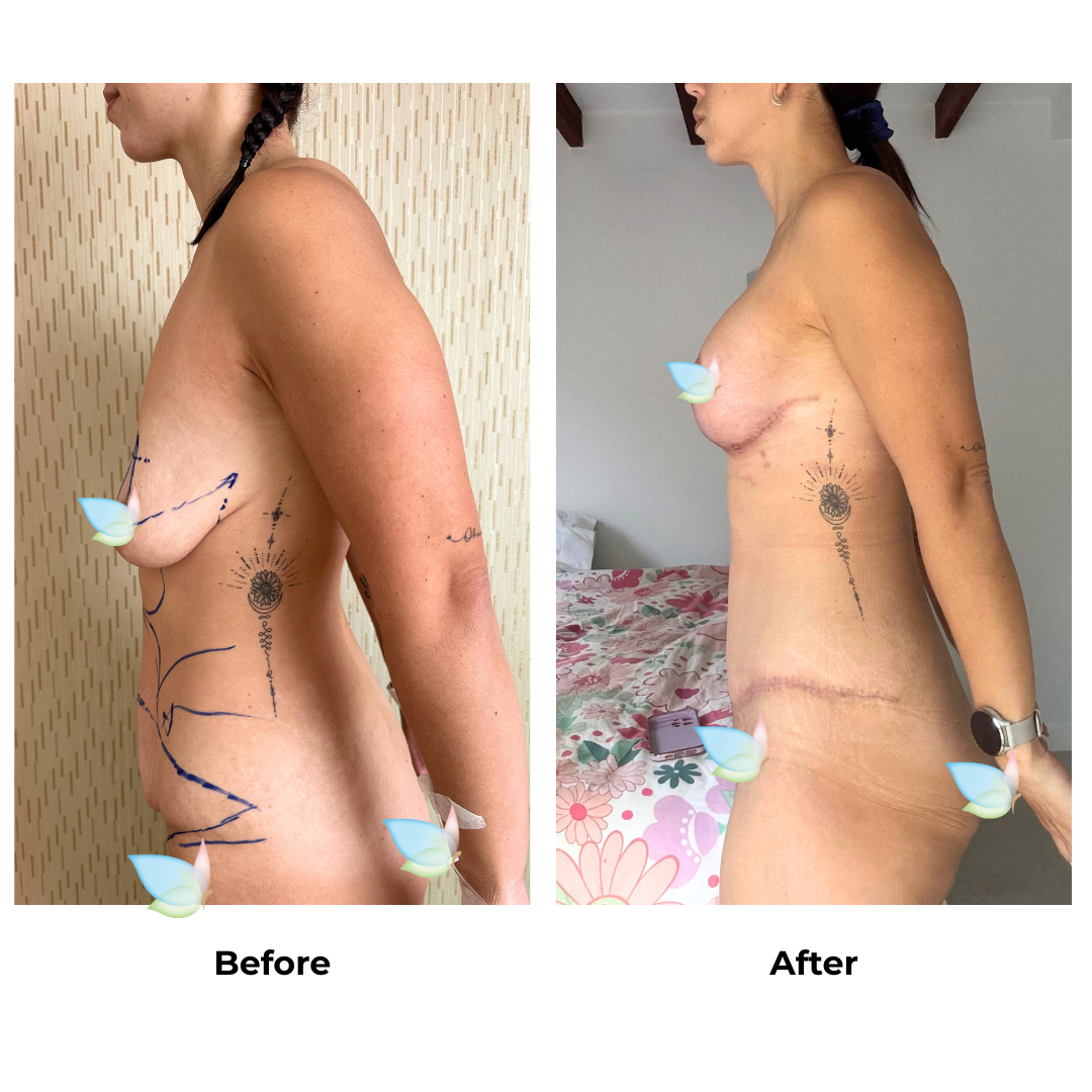 Sarah had BABL+ExTT+LipoX2 - Sarah Nobbs with Dr. Weerachai