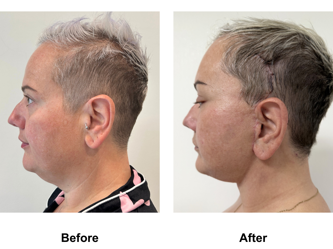 Sarah had MFNL + Chin Lift + Lipo under chin + Endo Brow Lift with D. Jatuporn (2)