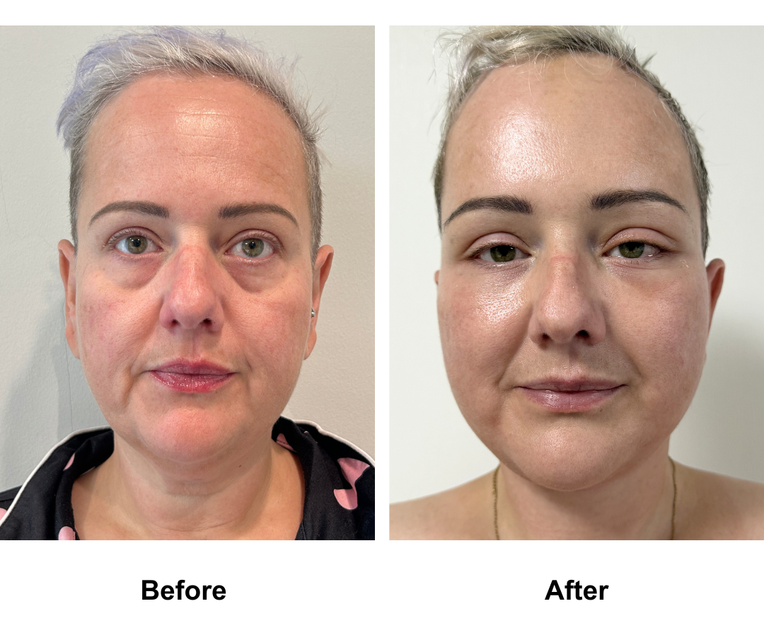 Sarah had MFNL + Chin Lift + Lipo under chin + Endo Brow Lift with D. Jatuporn
