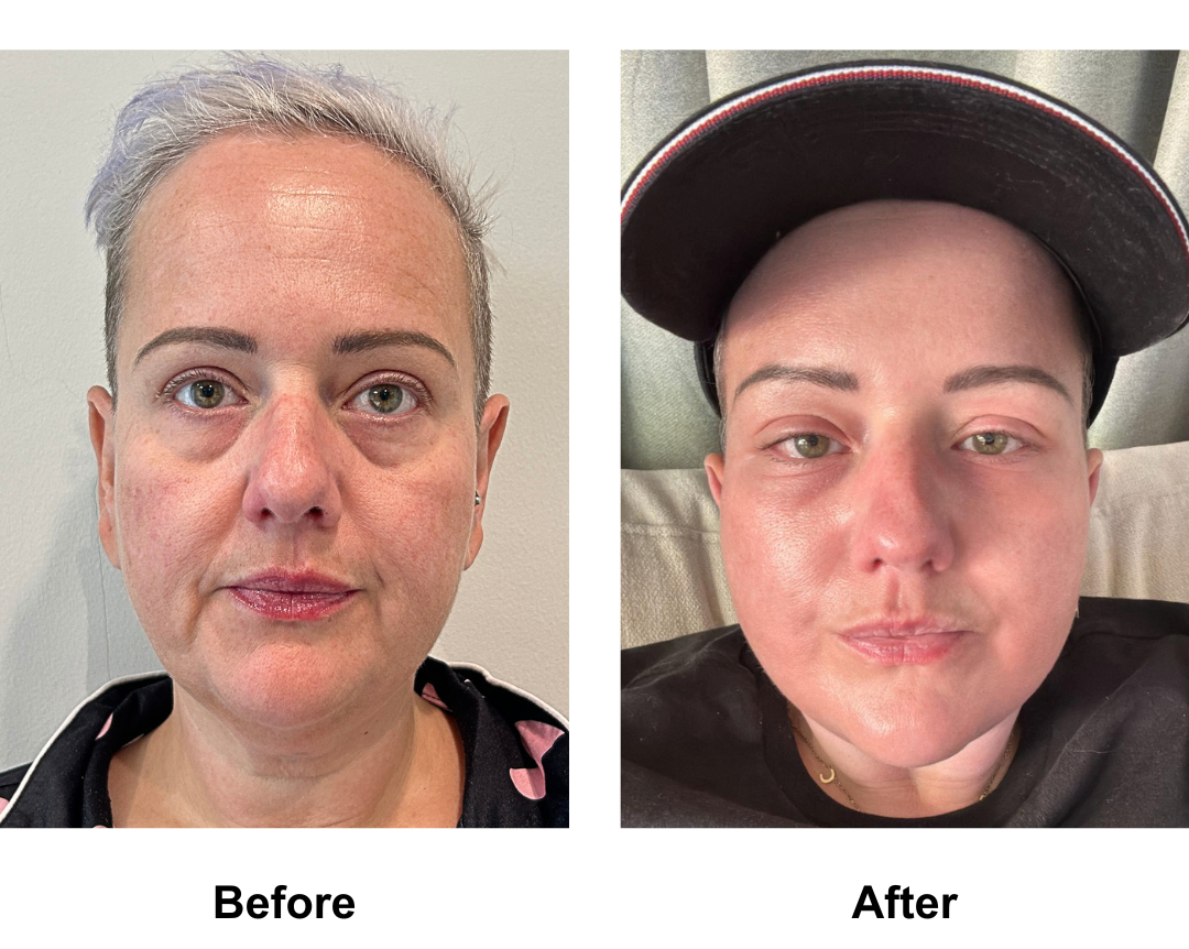 Sarah had MFNL + Chin Lift + Lipo under chin + Endo Brow Lift with Dr. Jatuporn