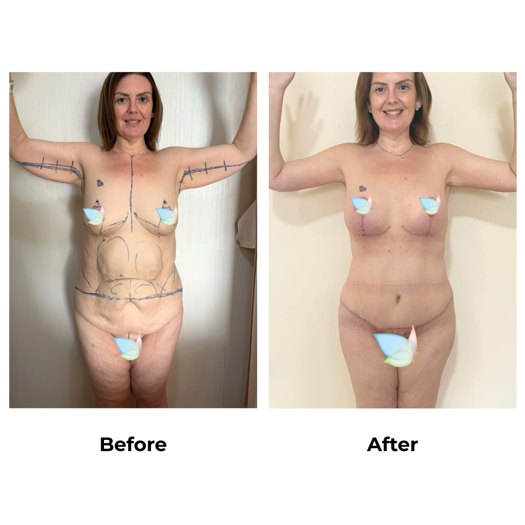 Sarah had skin removal with Dr. Weerachai - 9 weeks (2)