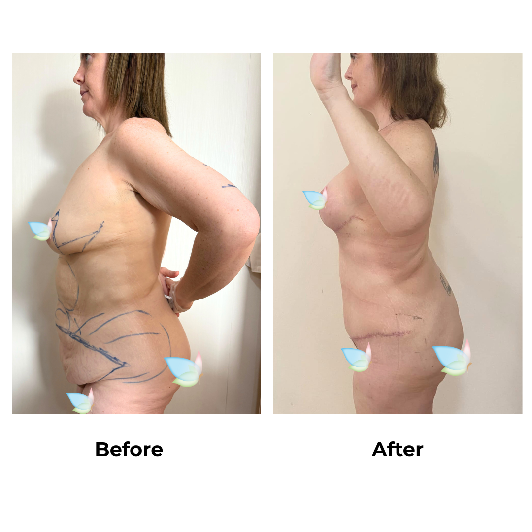 Sarah had skin removal with Dr. Weerachai - 9 weeks (3)