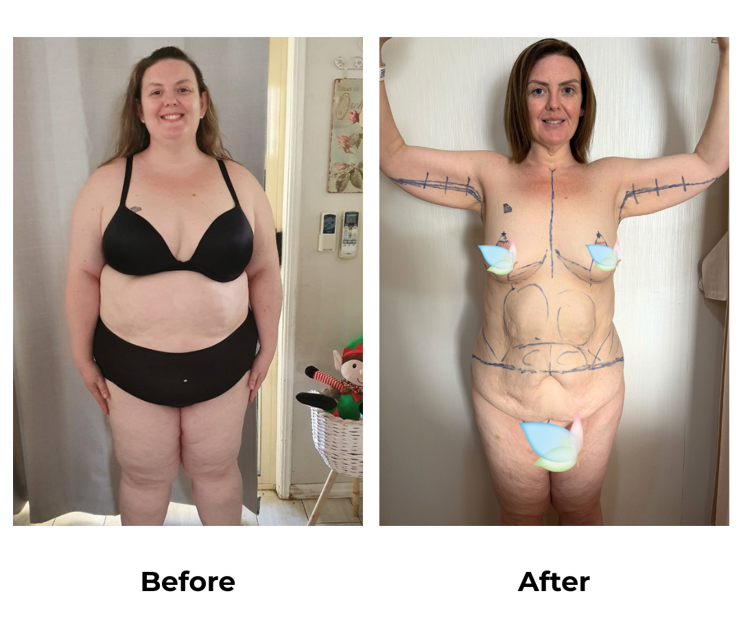 Sarah had weight loss surgery