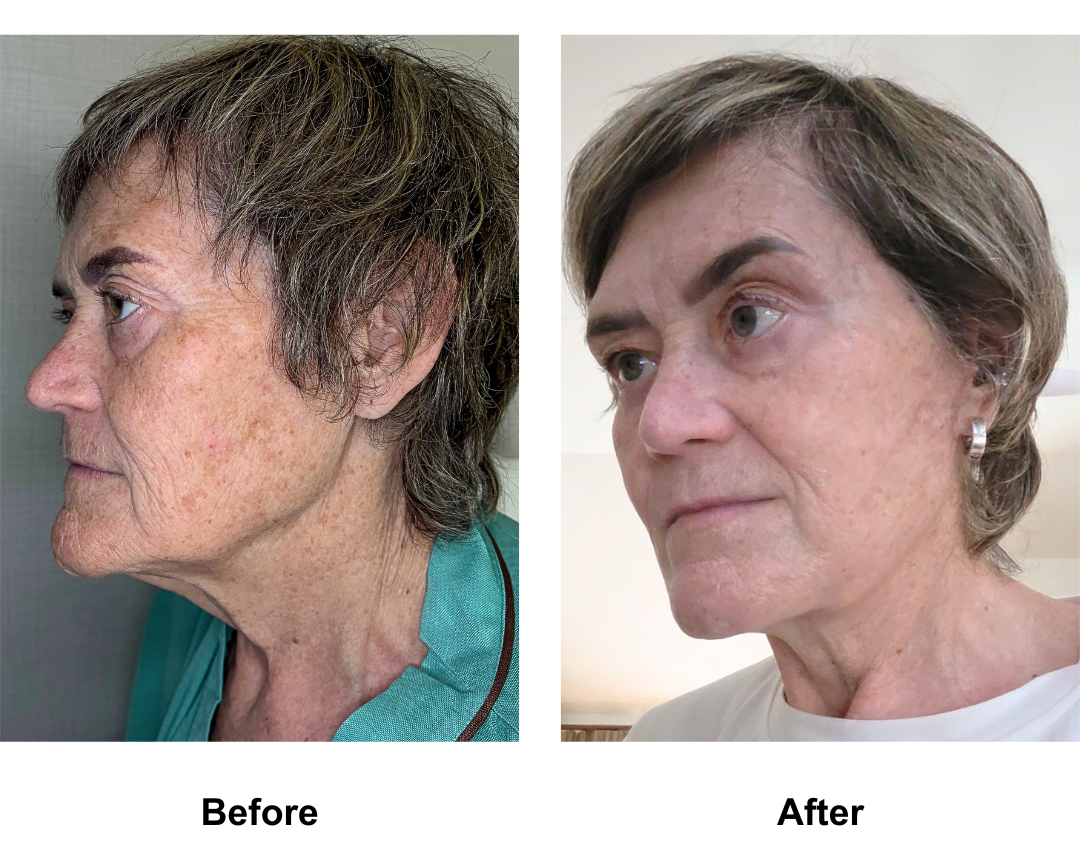 Sarah, 65 had MFNL + Chin lift with Dr. Ring (2)-1