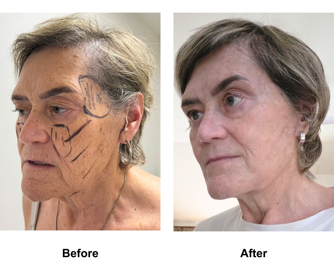 Sarah, 65 had MFNL + Chin lift with Dr. Ring (2)