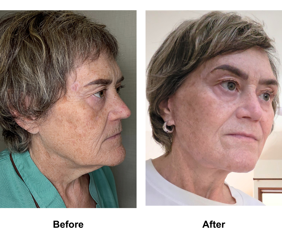 Sarah, 65 had MFNL + Chin lift with Dr. Ring (3)-1