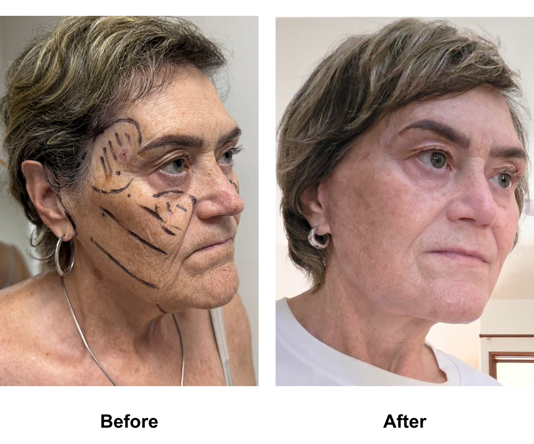 Sarah, 65 had MFNL + Chin lift with Dr. Ring (3)
